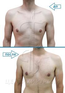 Фото до и после гинекомастии