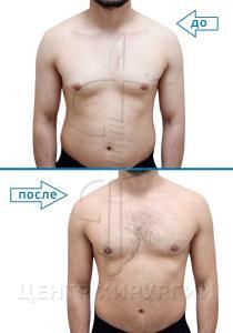 Результат устранение гинекомастии