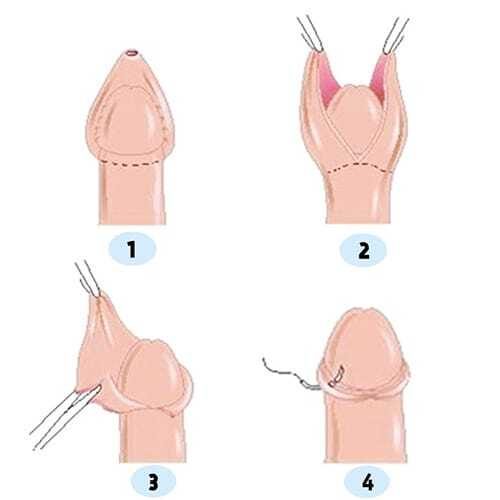 circumcision